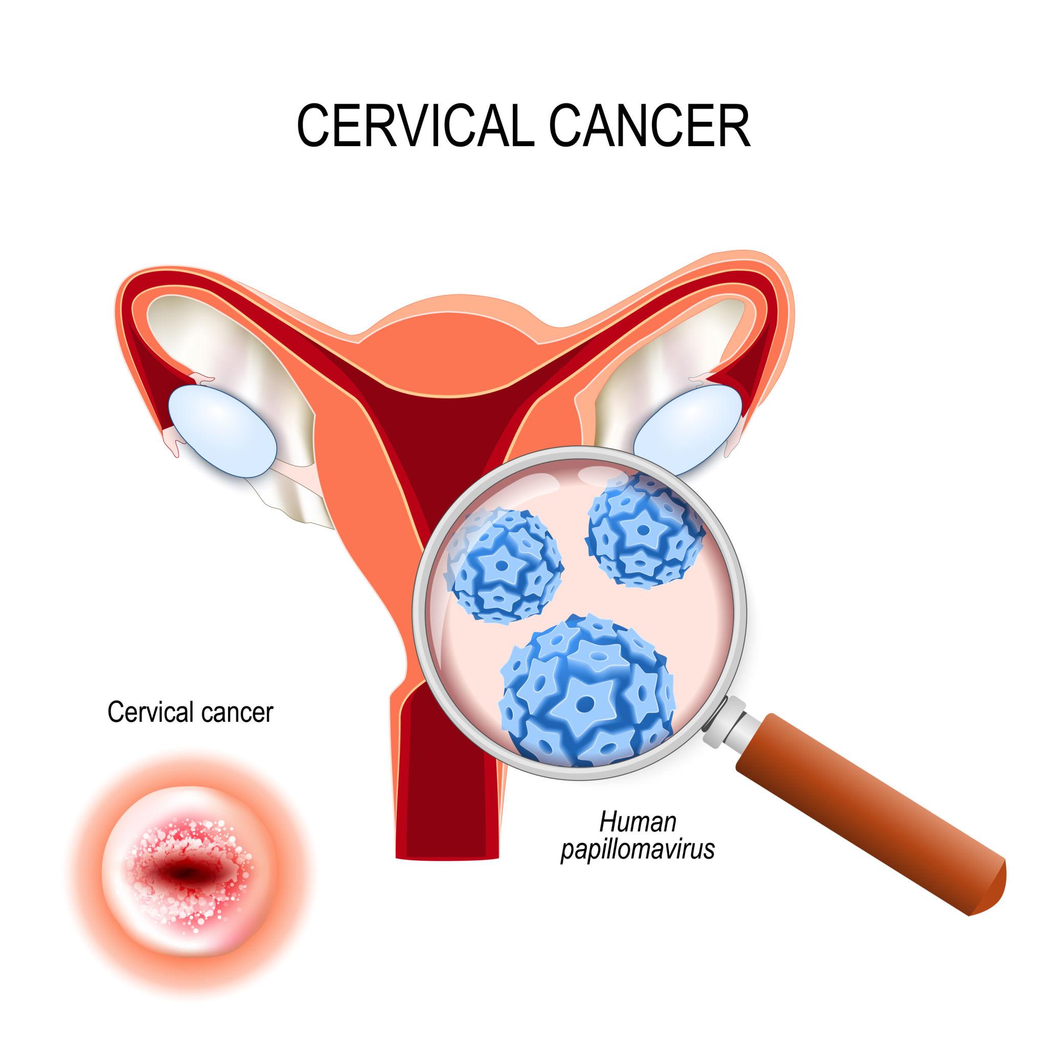 Laparoscopic Surgery for Cervical Cancer in Pune – Advanced Cancer Treatment
